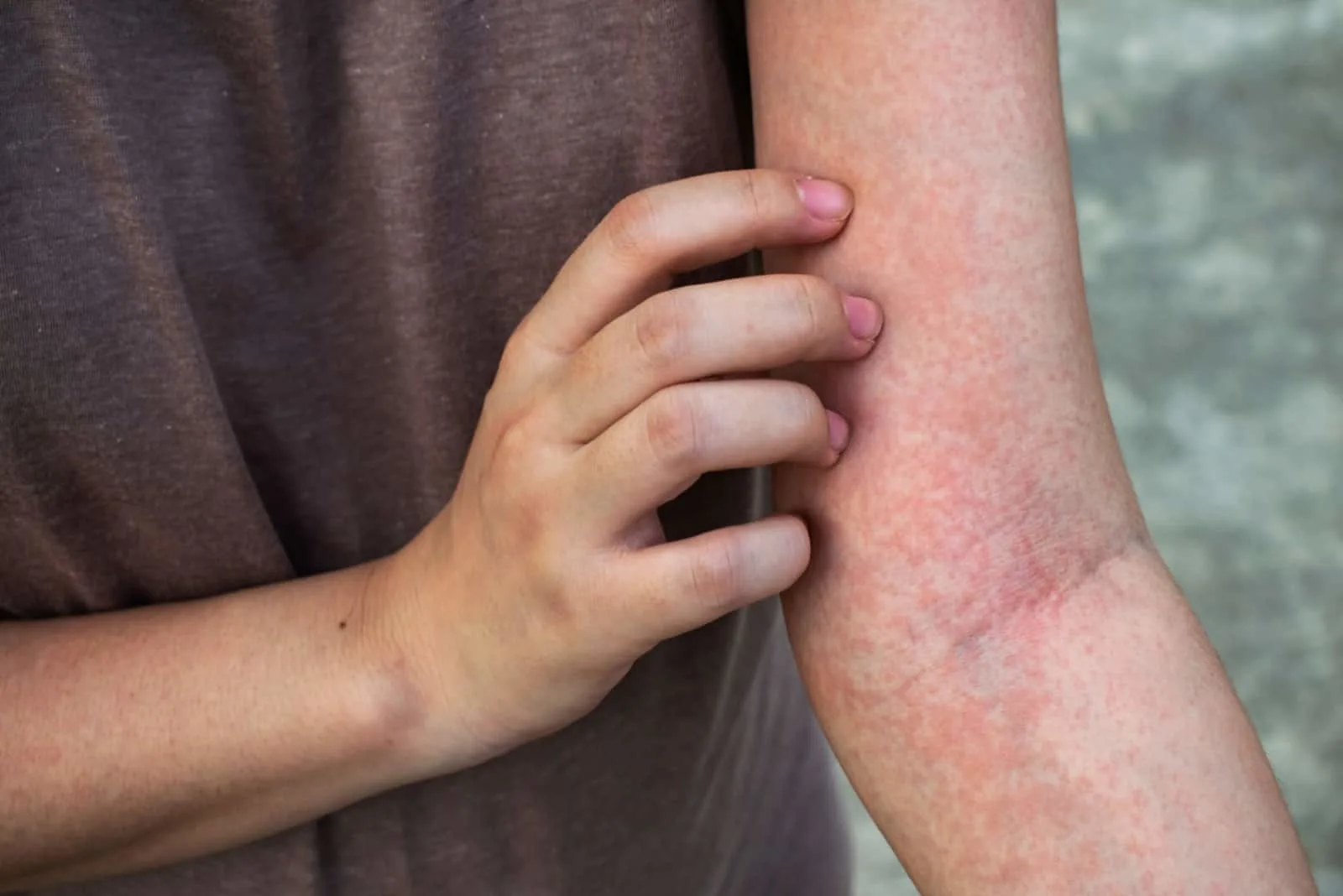 a man with a rash on his body