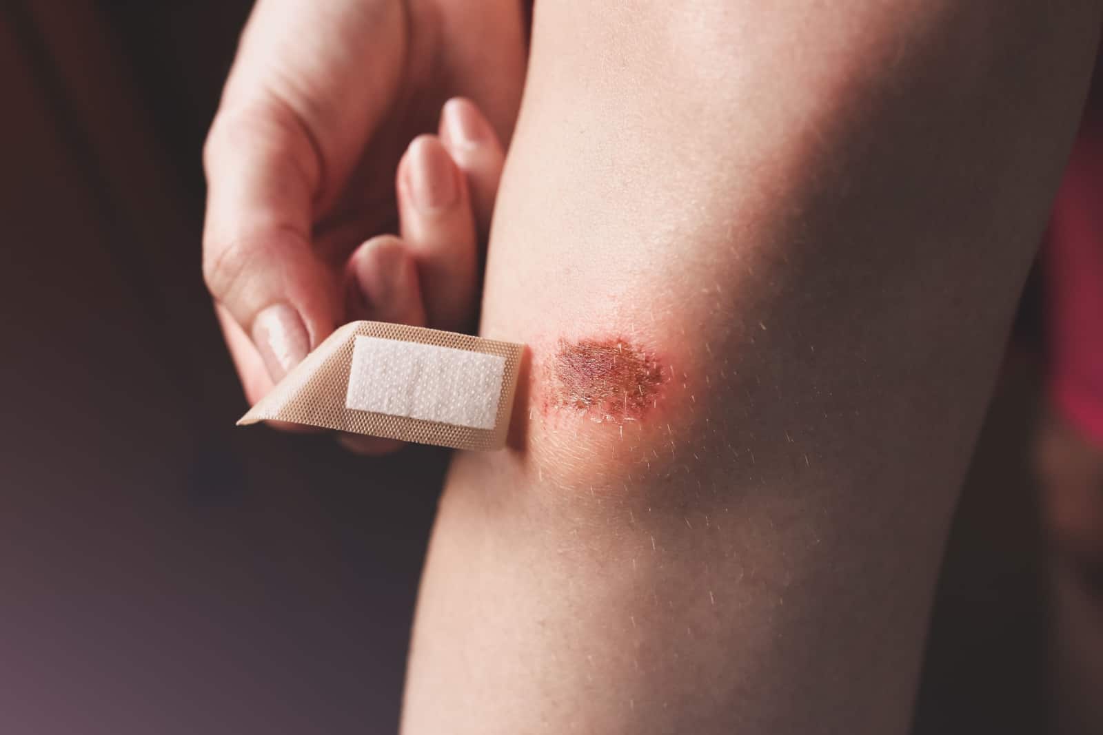 Girl is applying antiseptic band-aid plaster on the injured leg