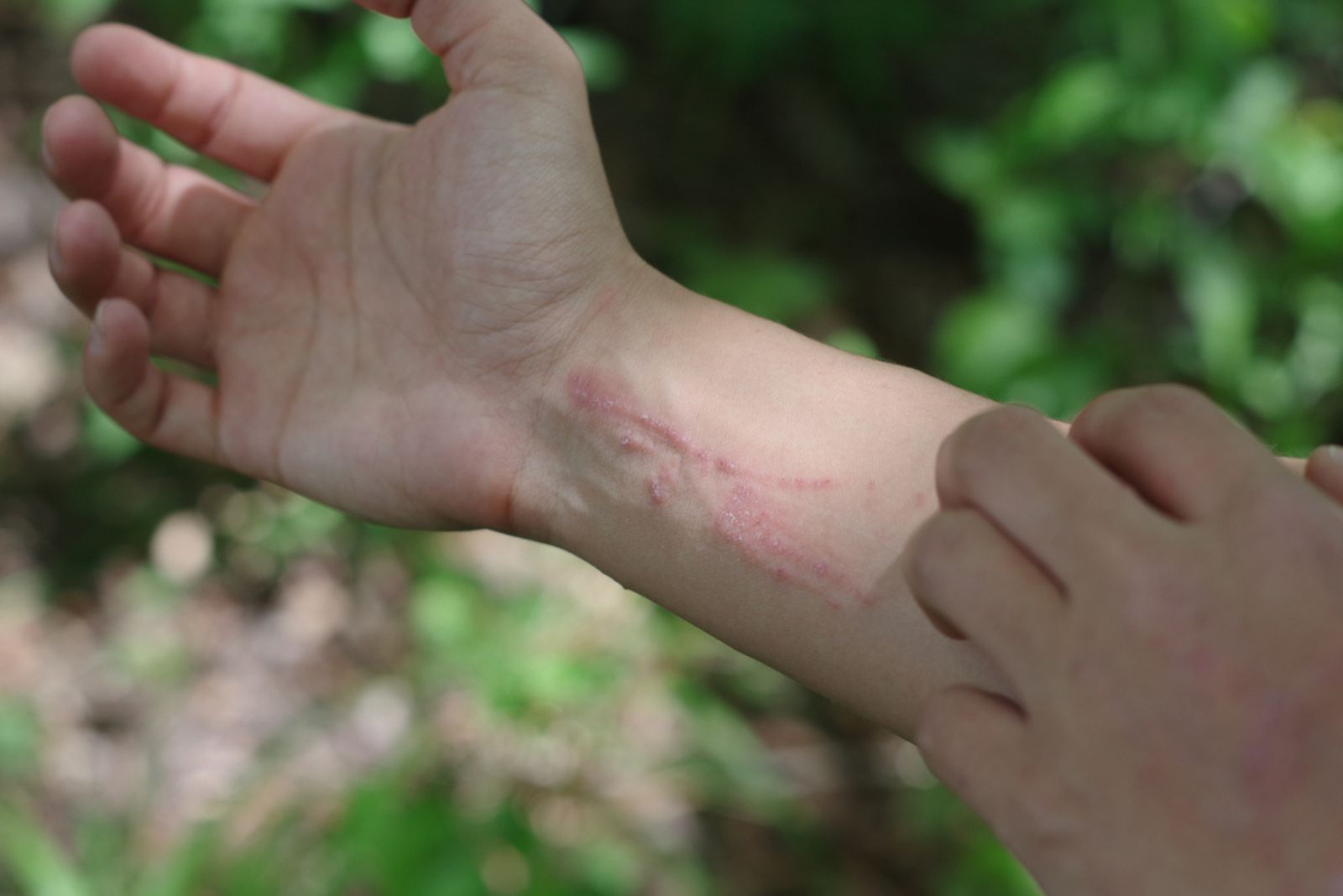 Poison Ivy Rash