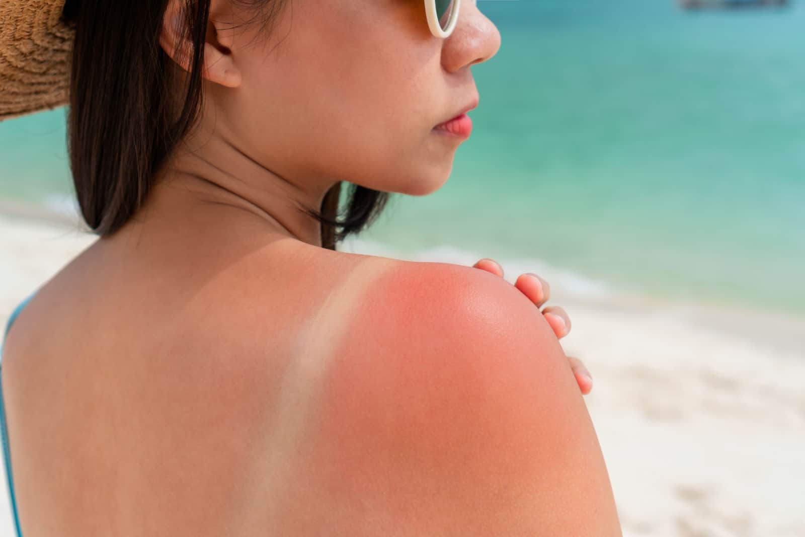 Sunburned skin on shoulder of a woman