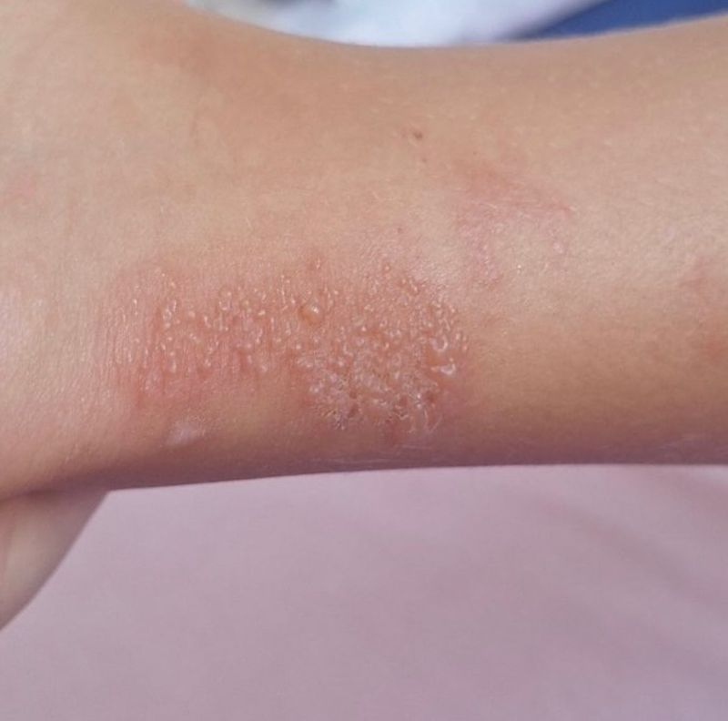 Severe Skin Burns