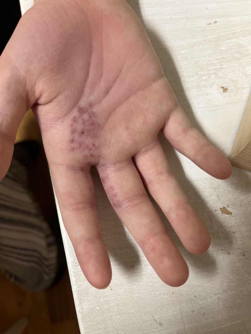 Avoid Contact Because Its Hairs Can Irritate Skin