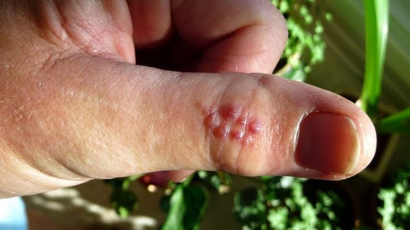 What Happens After Contact With Its Venomous Spines