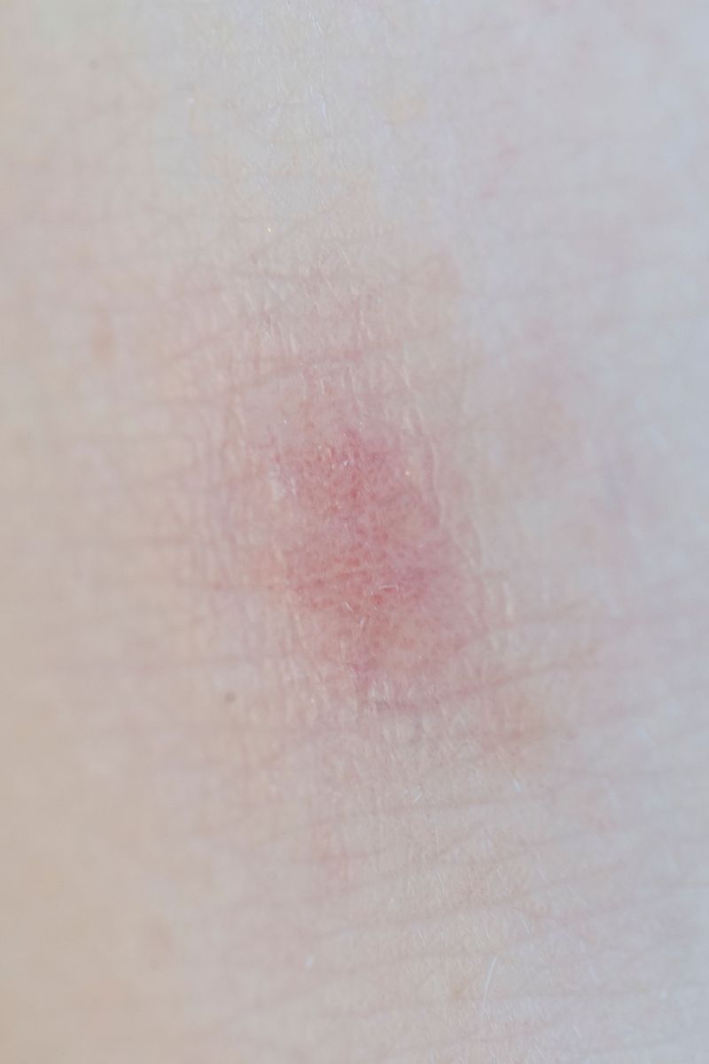 Sap Can Irritate Skin Sap Can Irritate Skin