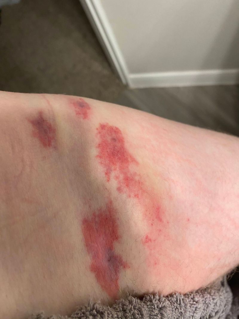 August May Feel Like Fall, But Chiggers Still Disagree August May Feel Like Fall, But Chiggers Still Disagree