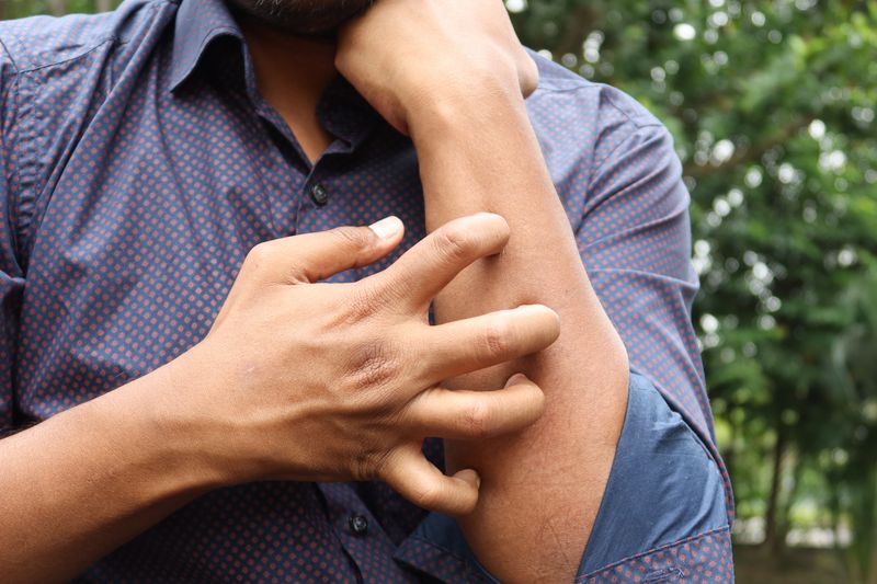Bites From Chiggers Cause Intense Itching Within Hours Bites From Chiggers Cause Intense Itching Within Hours