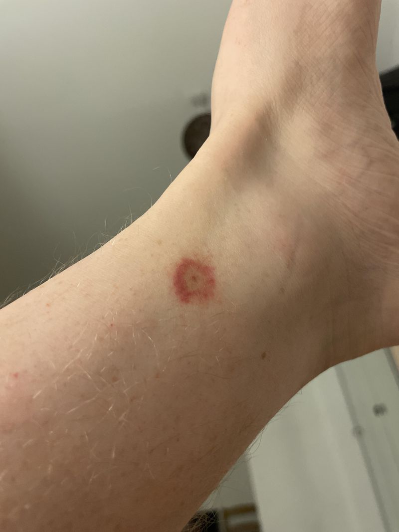 Lyme Disease Cases Climb Sharply This Month