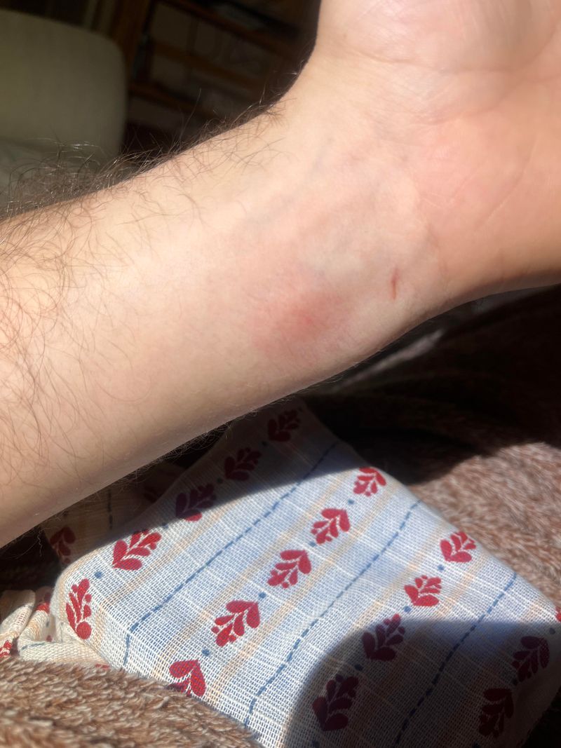 Use A Wrapped Cold Pack For Pain And Swelling