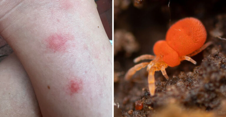 Why Chigger Bites Get Worse In Ohio On Late August, Not Better