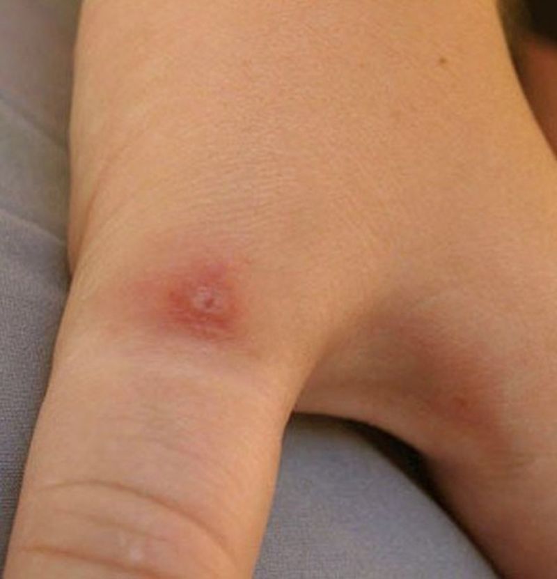 Do Not Assume Every Spider Bite Is A Black Widow Bite