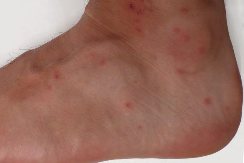 They Don't Burrow Into Your Skin They Don't Burrow Into Your Skin