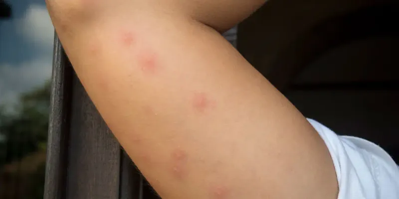 A welt does not identify its cause