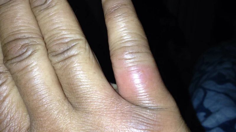 Call for guidance after a possible bite