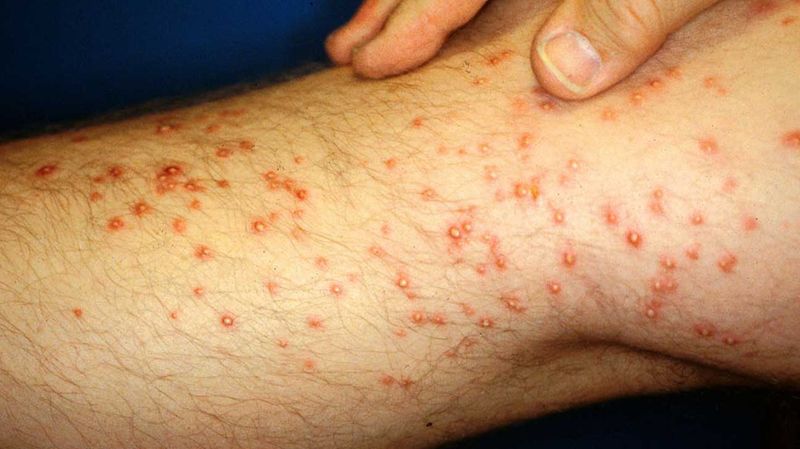 Expect White Pustules, And Don't Pop Them