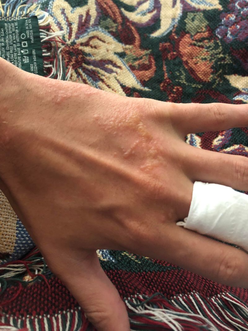 Its Oil Triggers Severe, Blistering Rashes