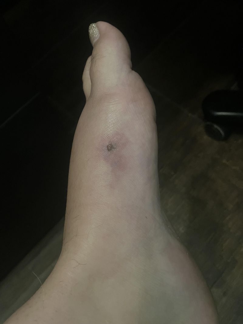 Keep The Bitten Arm Or Leg Still