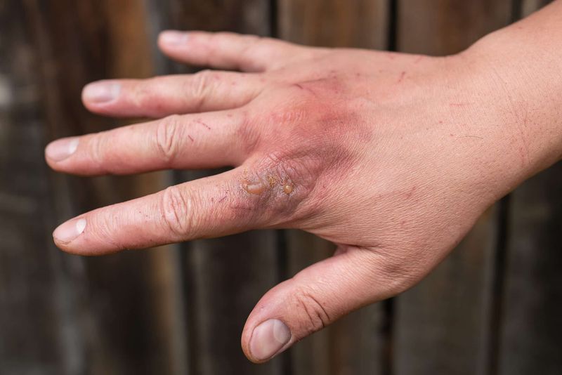 Know The Signs Of A Serious Allergic Reaction