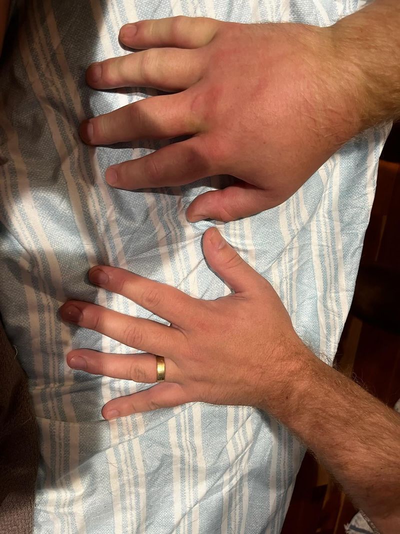 Watch For Allergic Reactions After A Sting Watch For Allergic Reactions After A Sting