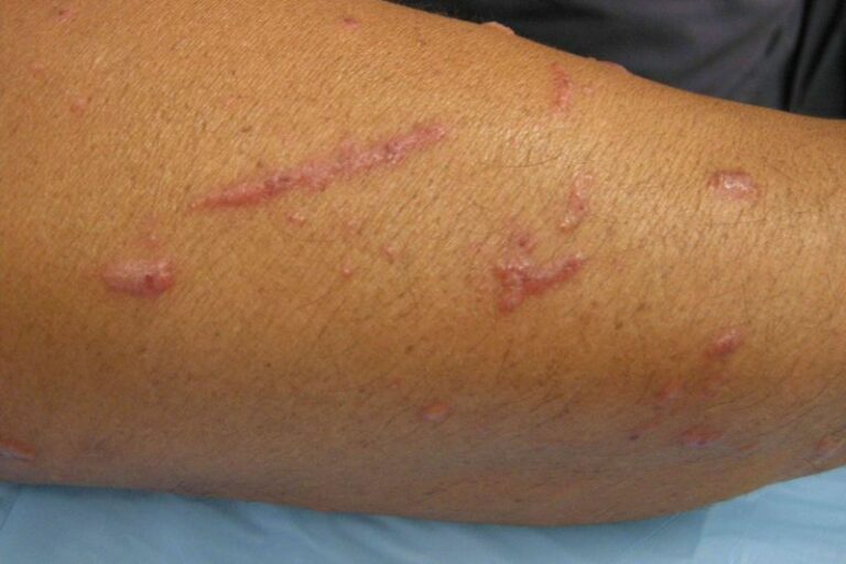 That Itchy Welt After Pulling Arizona Weeds May Not Be a Bite at All